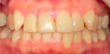 ホワイトニング施術前