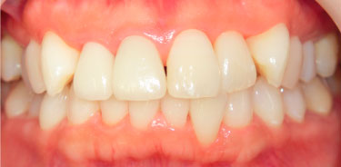 ホワイトニング施術後